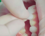 Bọc răng sứ không mài có tốt không? Trường hợp áp dụng