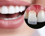 Dán răng sứ không mài răng uy tín chất lượng tại Nha Khoa VVS