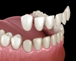 Dán Veneer tại Quận 1 chất lượng - Nha Khoa VVS uy tín, chuyên nghiệp
