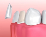 Dán Veneer tại TPHCM ở đâu tốt? Tiêu chí lựa chọn nha khoa uy tín