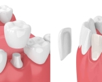 Làm răng sứ tại TPHCM ở đâu tốt? Tiêu chí chọn nha khoa để làm răng sứ