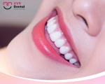 Dịch vụ làm răng sứ trả góp tại TPHCM - Trả góp 0% lãi suất