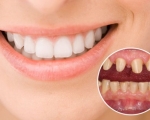 Tác hại bọc răng sứ và cách phòng tránh hiệu quả