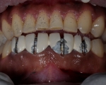 Tác hại của răng sứ kim loại bạn cần phải lưu ý