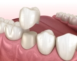 Tư vấn làm răng sứ tại TPHCM - Địa chỉ bọc răng sứ uy tín 