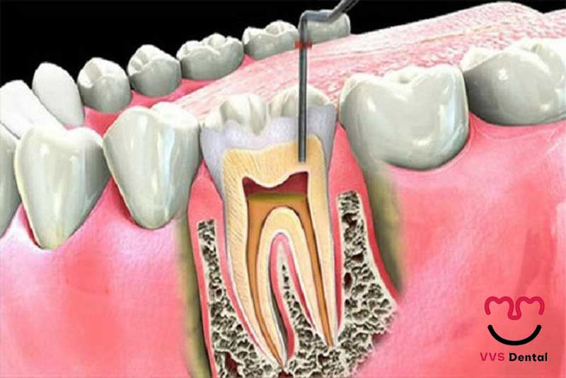 điều trị tủy răng tại Nha Khoa VVS uy tín