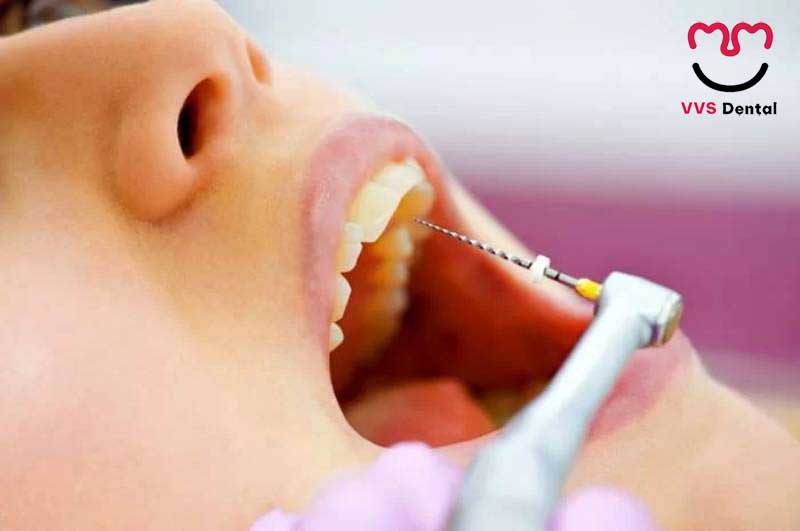 điều trị tủy răng tại Nha Khoa VVS uy tín