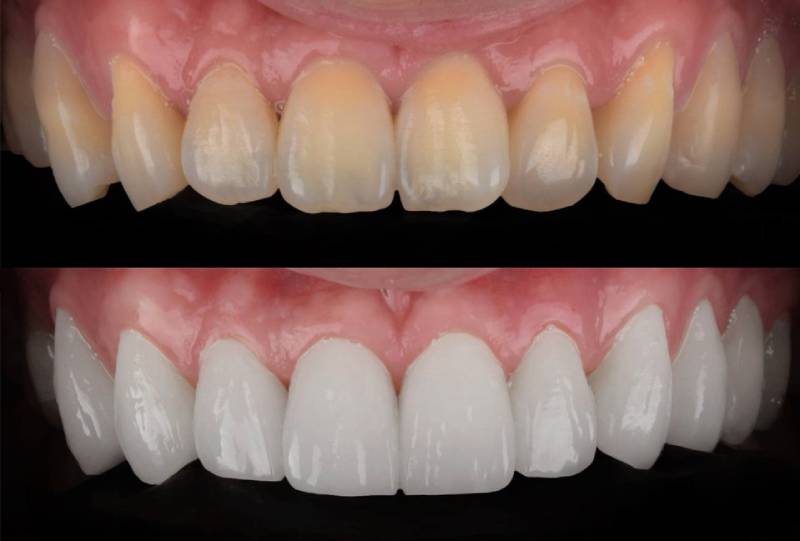 Dán sứ Veneer không mài răng tại quận 10