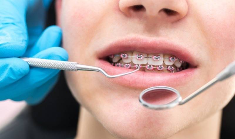 Niềng răng mắc cài mặt trong