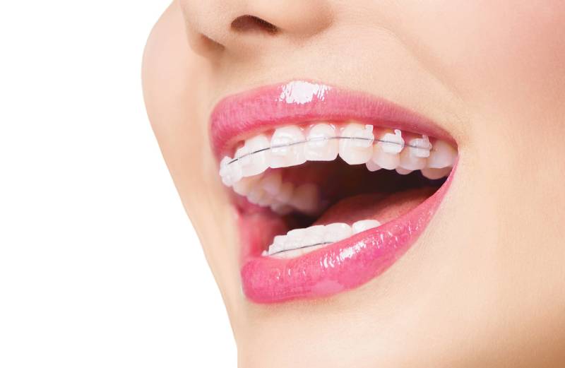 Dịch vụ niềng răng tại Nha Khoa VVS