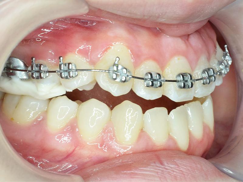 Dịch vụ niềng răng tại Nha Khoa VVS