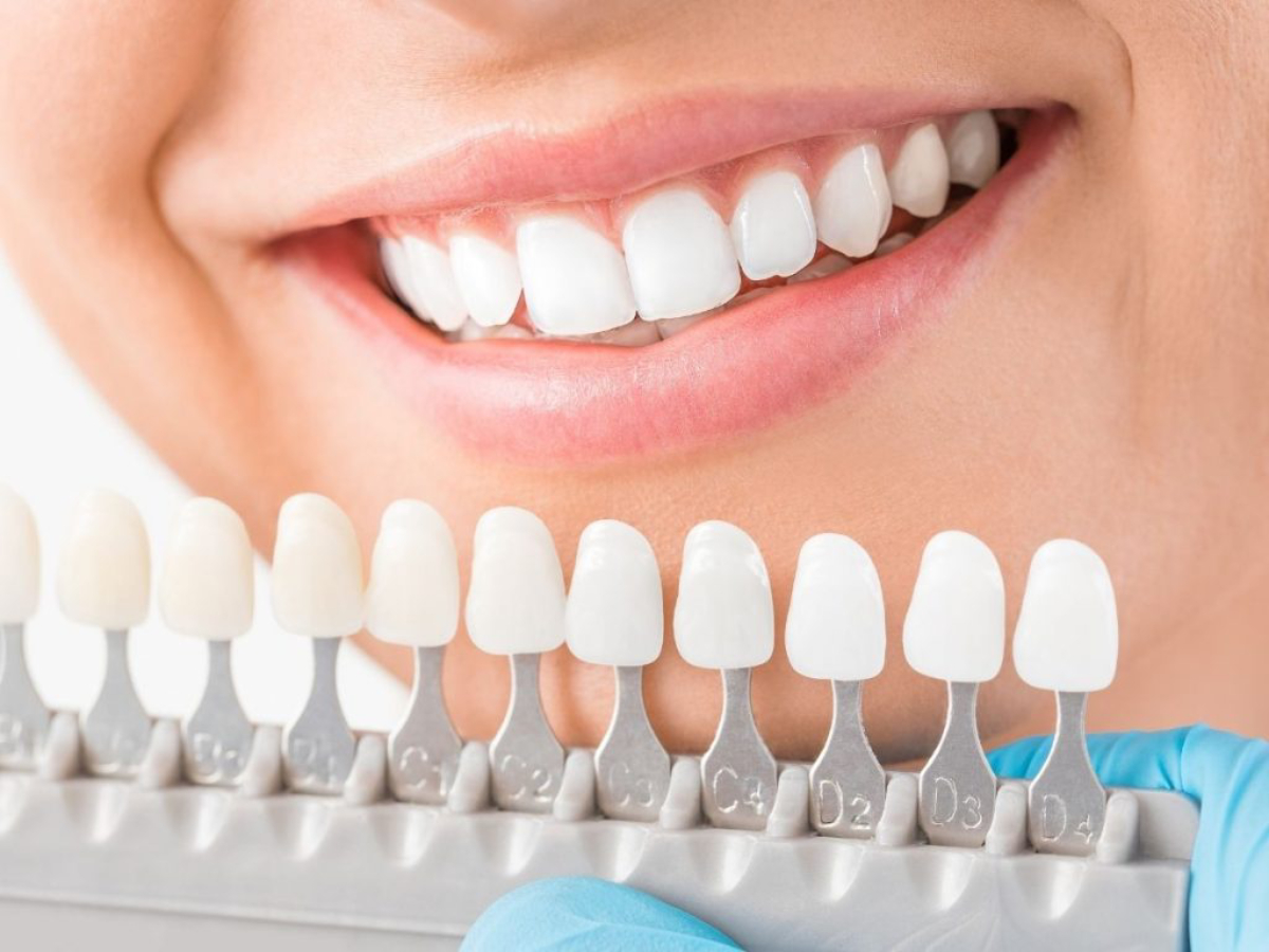 bọc răng sứ không mài có tốt không