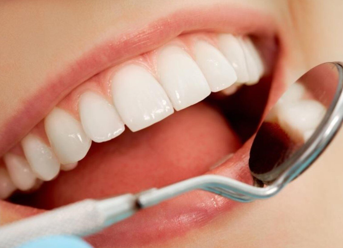 bọc răng sứ không mài có tốt không