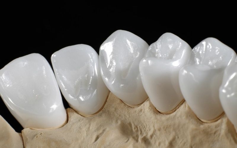 bọc răng sứ loại nào tốt