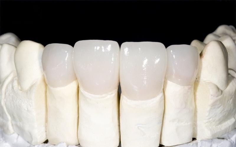 bọc răng sứ loại nào tốt
