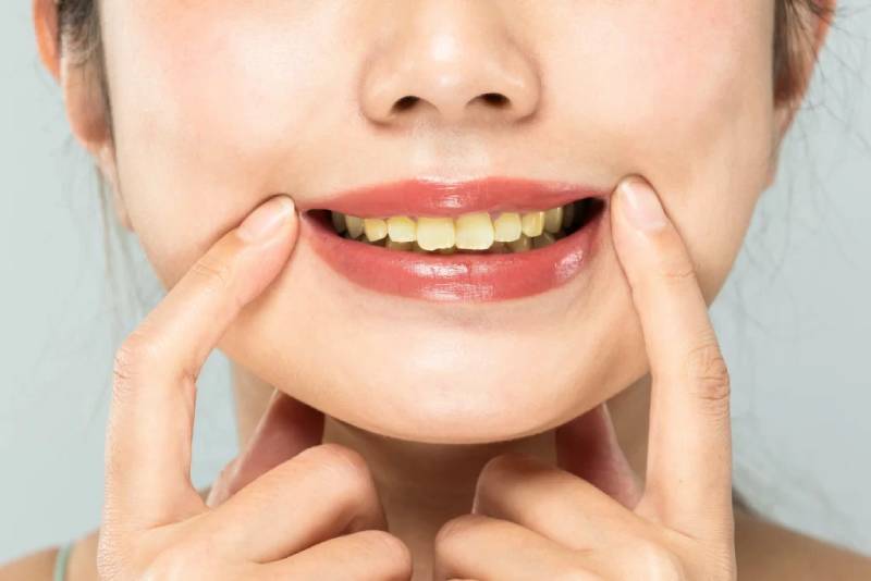 bọc răng sứ Nha Khoa VVS tại Quận 10