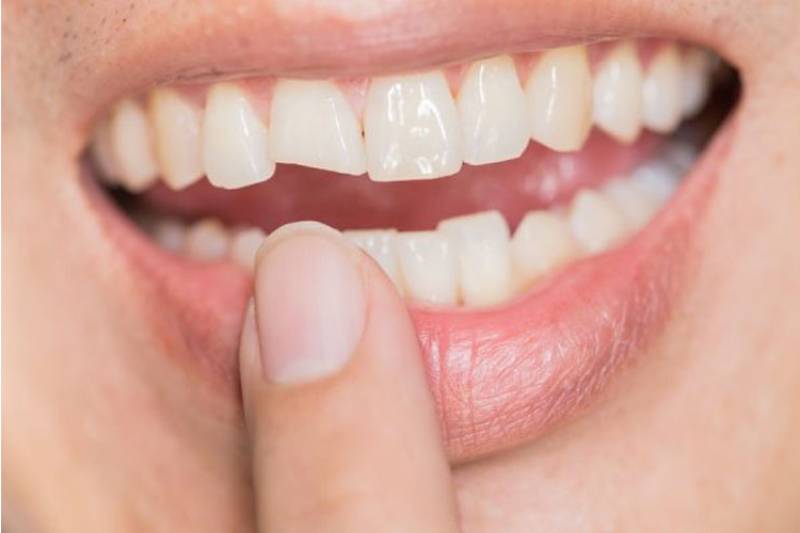 bọc răng sứ Nha Khoa VVS tại Quận 10