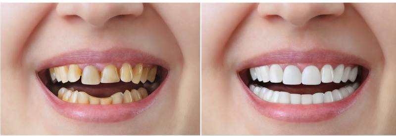 bọc răng sứ Nha Khoa VVS tại Quận 10