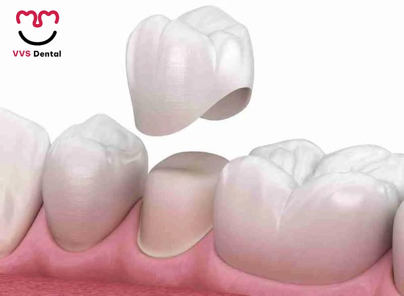 bọc răng sứ sau khi điều trị tủy tại Nha Khoa VVS