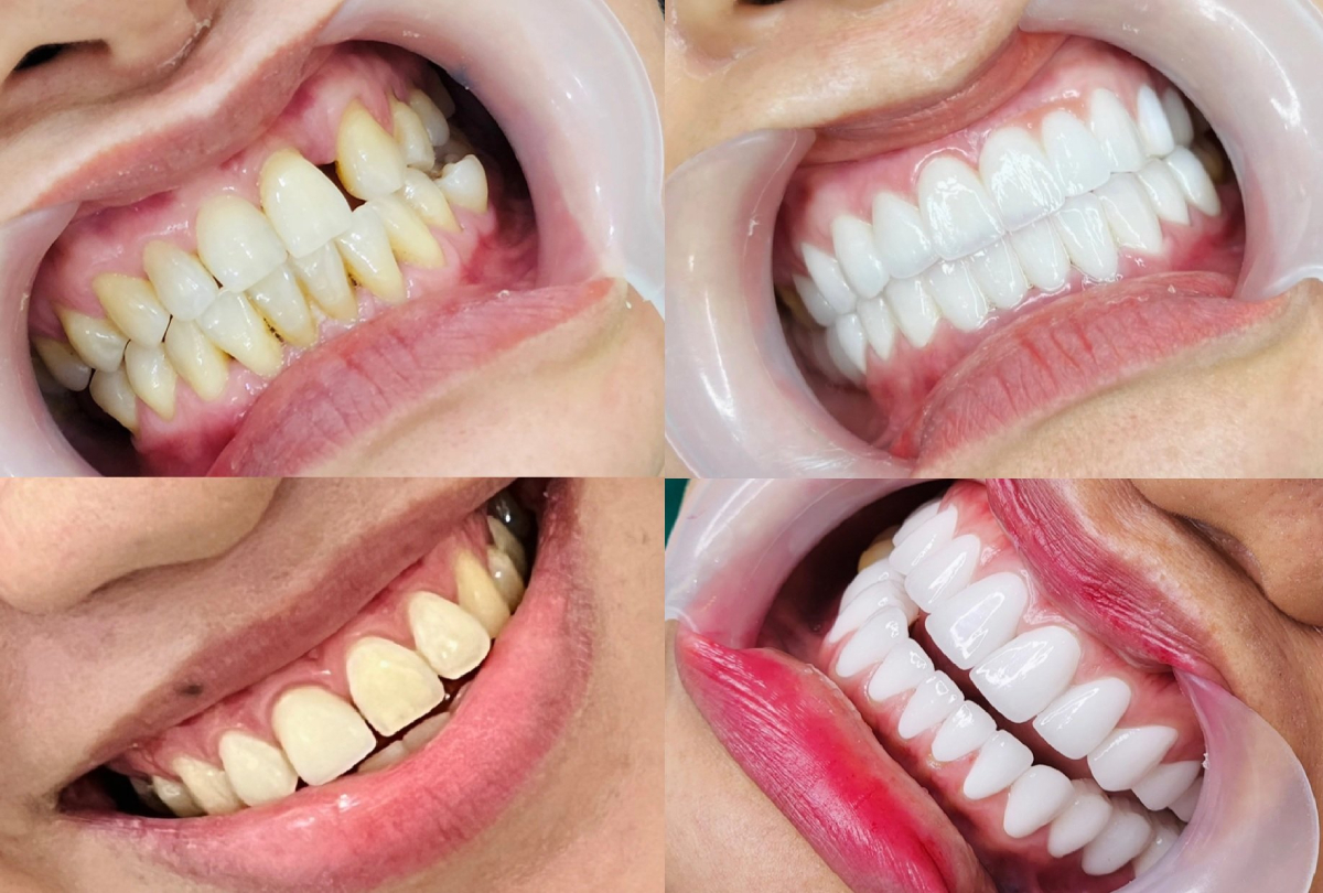 dán răng sứ không mài răng