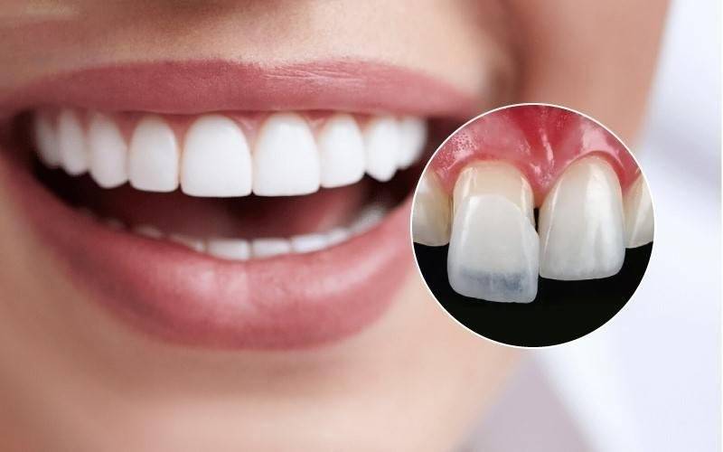 dán sứ veneer không mài răng tại Nha Khoa VVS