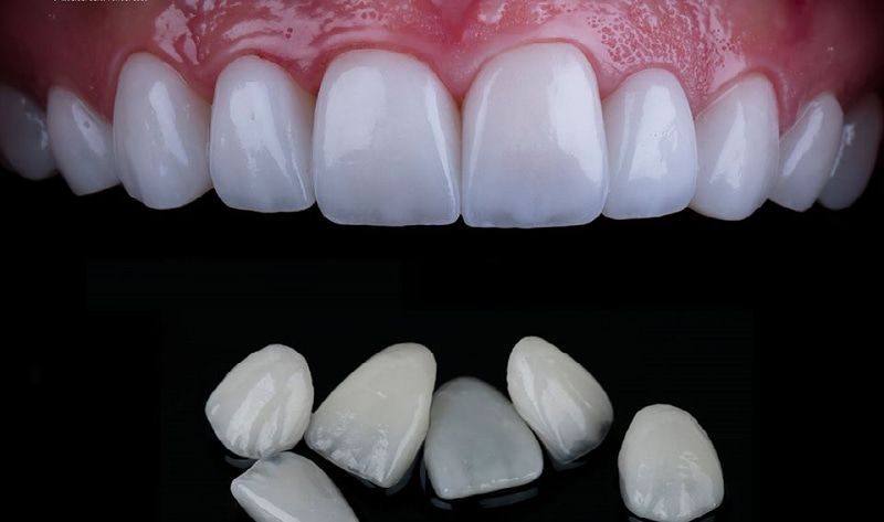 dán sứ veneer không mài răng tại Nha Khoa VVS