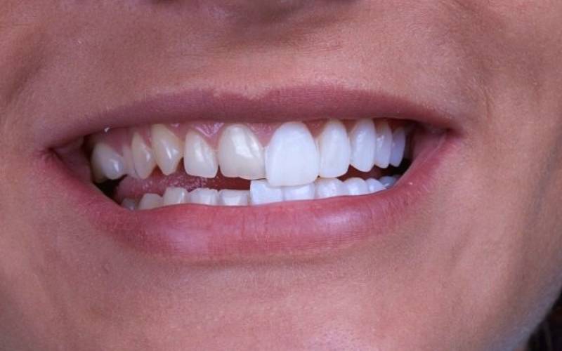 dán sứ veneer không mài răng tại Nha Khoa VVS