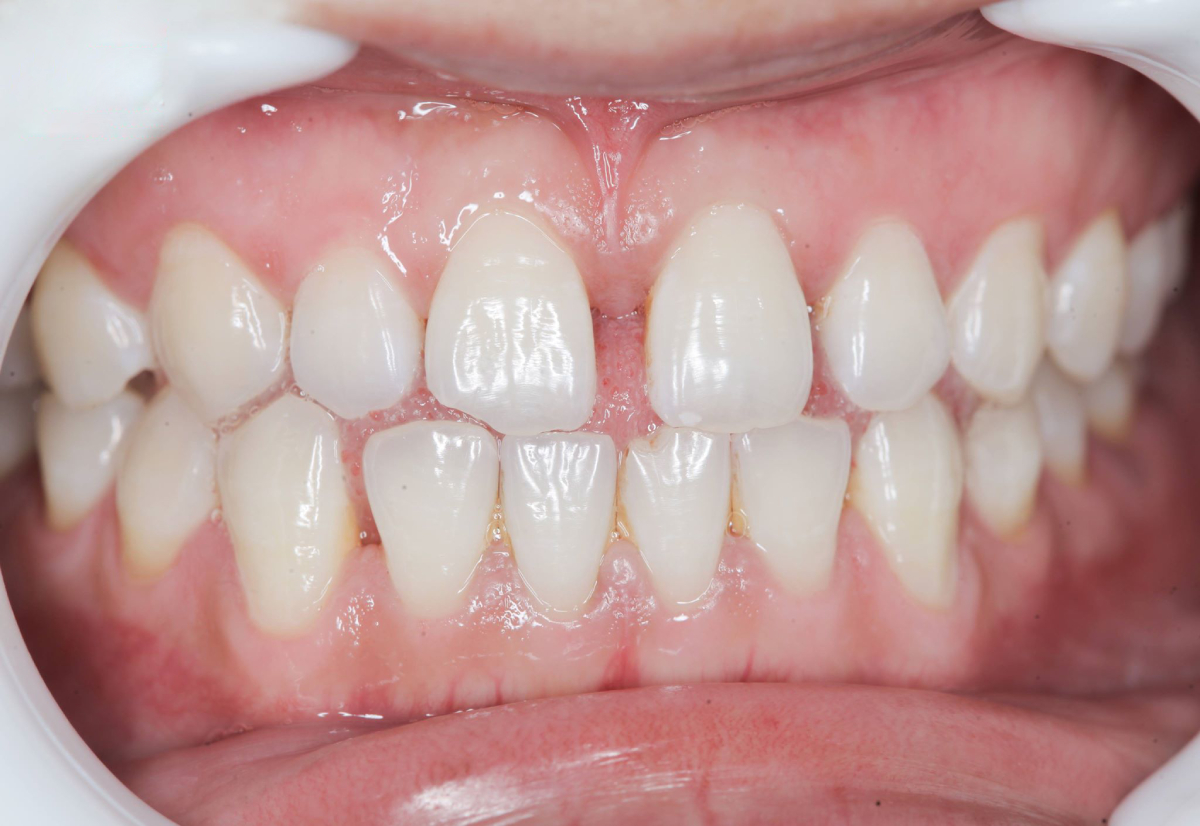 dán veneer răng thưa tại Quận 1