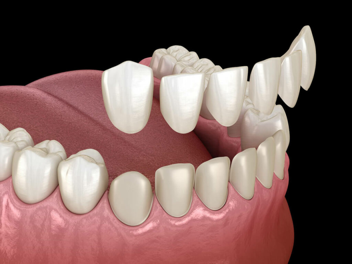 dán veneer răng thưa tại Quận 1