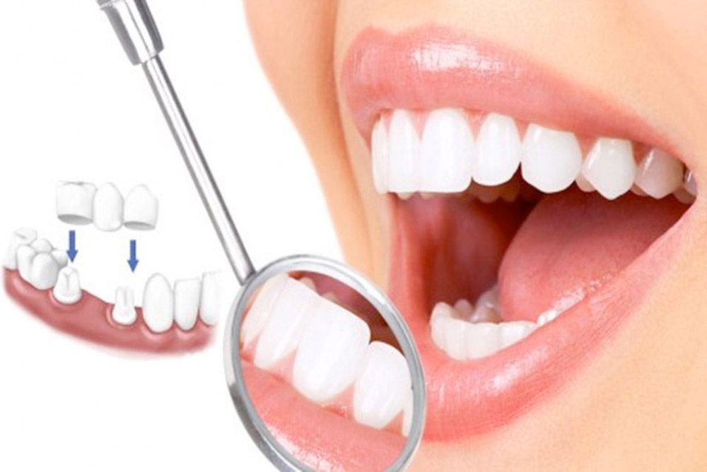 dịch vụ làm răng sứ