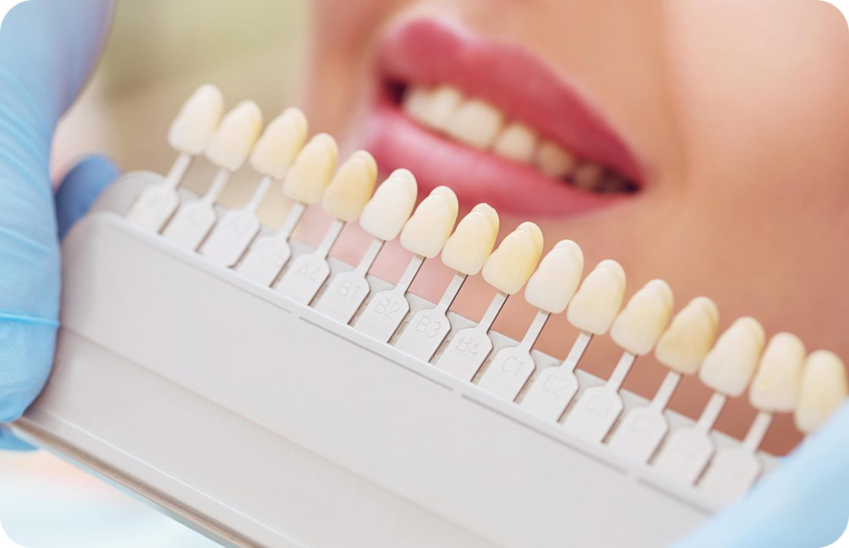 dán veneer tại quận 1