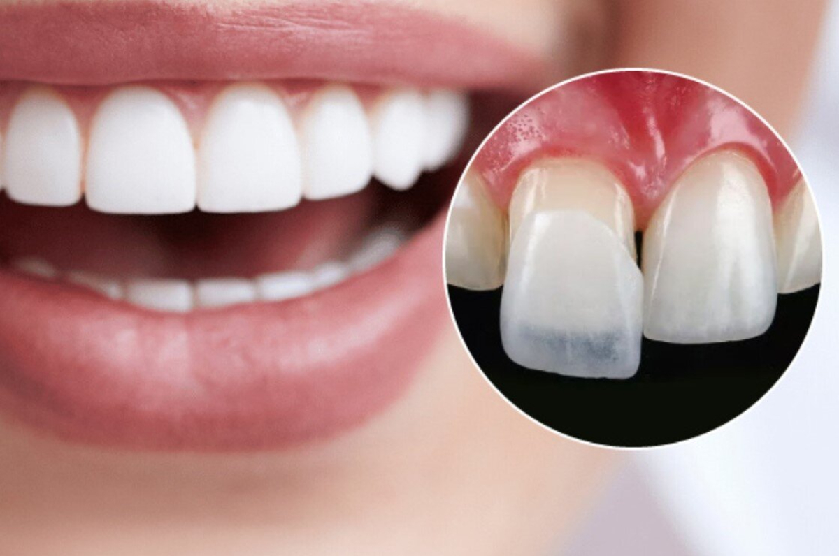 dán veneer tại quận 1