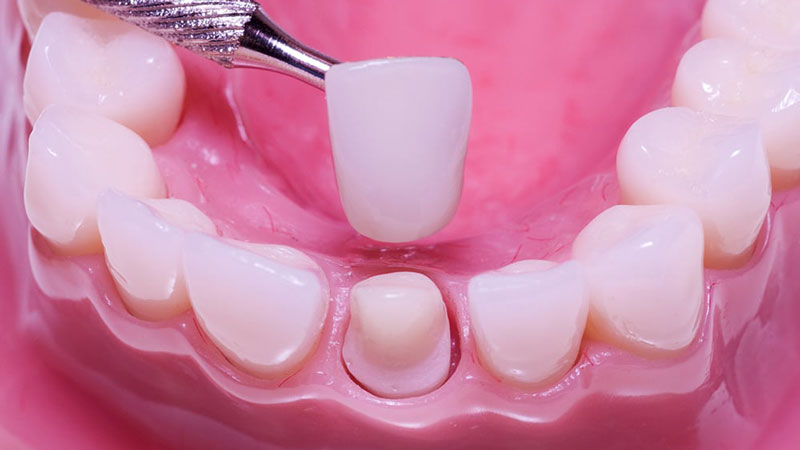 dịch vụ bọc răng sứ tại Nha Khoa VVS