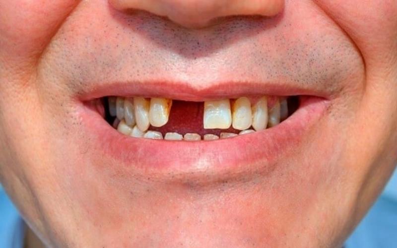 dịch vụ cấy ghép Implant tại Nha Khoa VVS