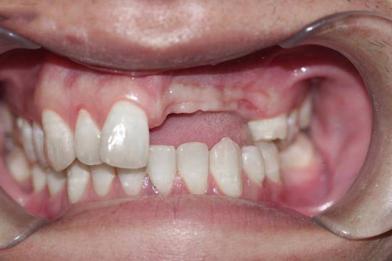 dịch vụ cấy ghép Implant tại Nha Khoa VVS