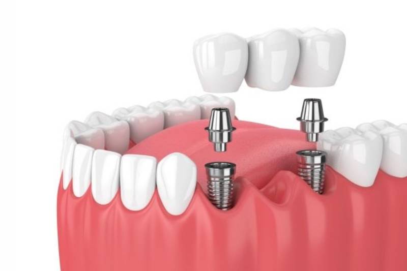 dịch vụ cấy ghép Implant tại Nha Khoa VVS