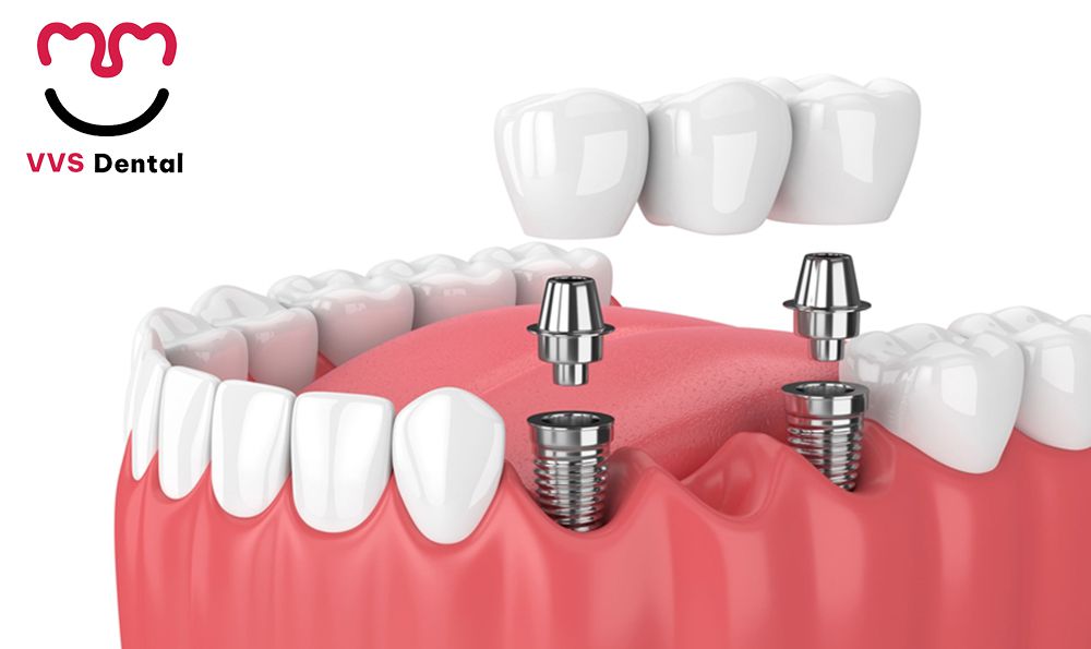 dịch vụ cấy ghép Implant