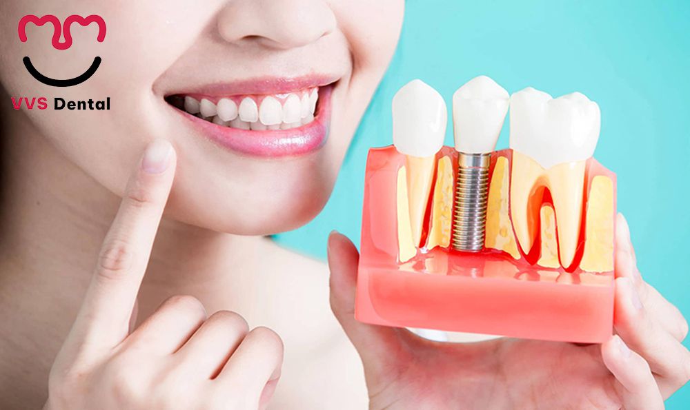 cấy ghép Implant