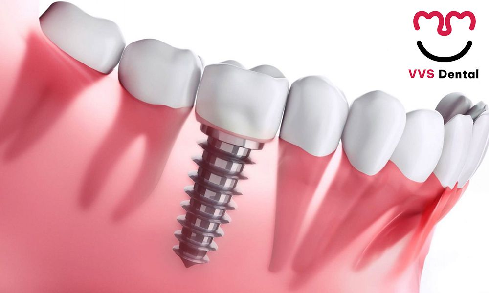 cấy ghép Implant
