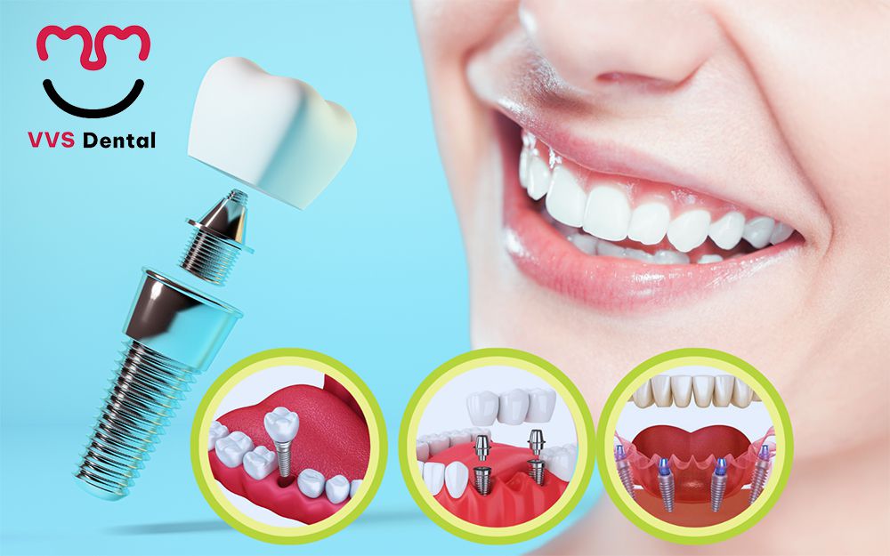 dịch vụ cấy ghép Implant