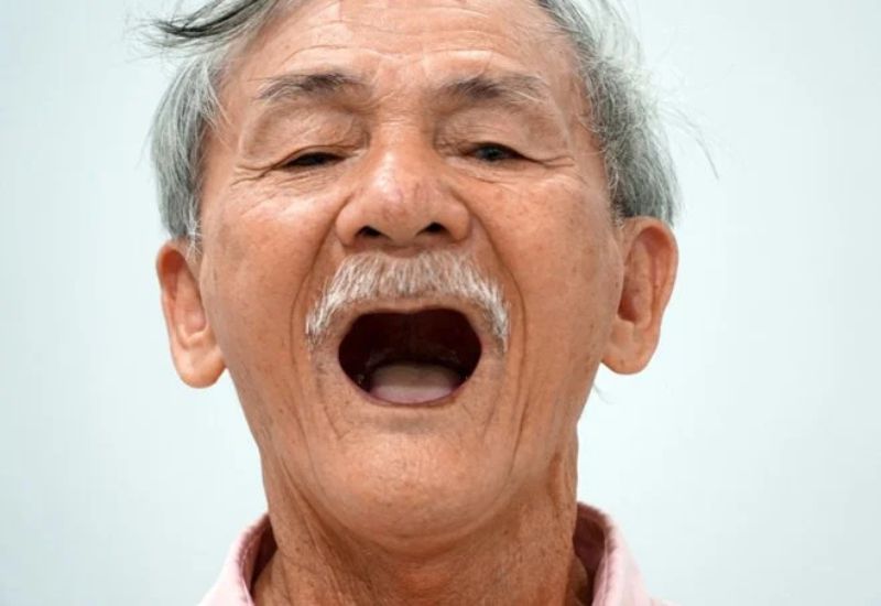 hàm răng giả tháo lắp cho người già