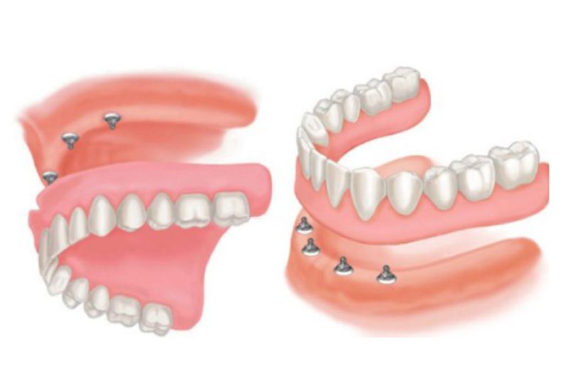 hàm răng giả tháo lắp cho người già