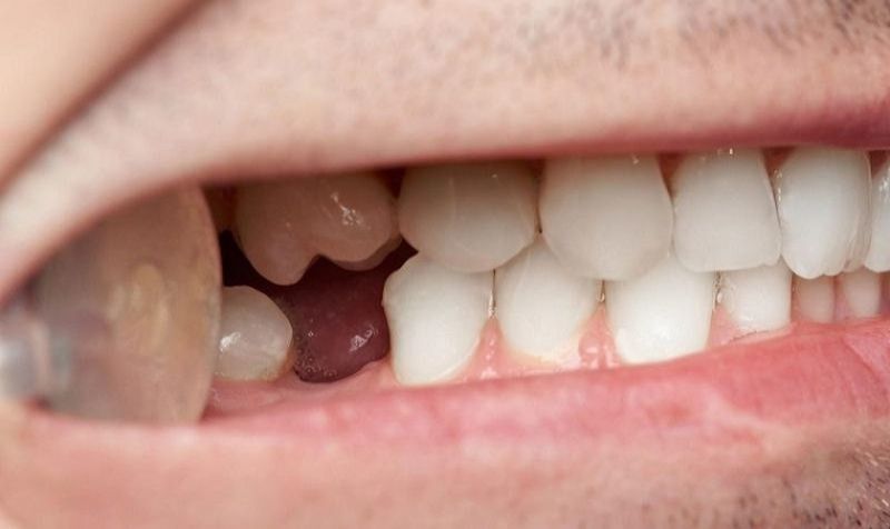 mất răng có bọc sứ được không