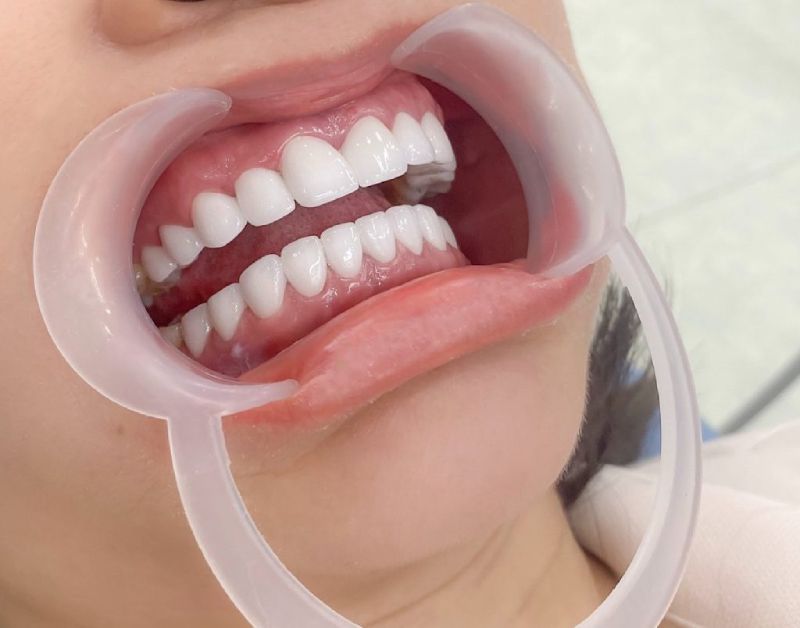 mất răng có bọc sứ được không