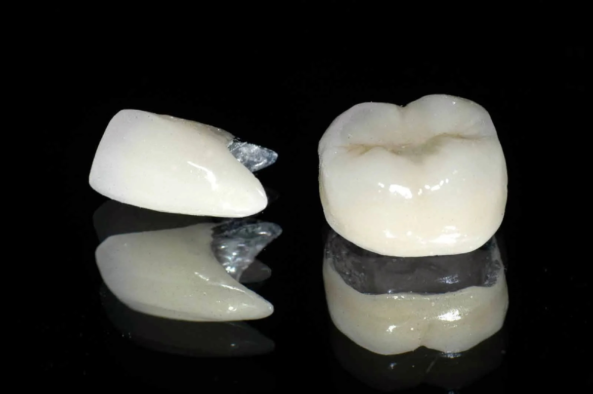 nên bọc răng sứ kim loại hay titan