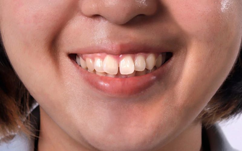 những trường hợp không nên bọc răng sứ