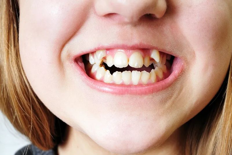 răng khấp khểnh có bọc sứ được không