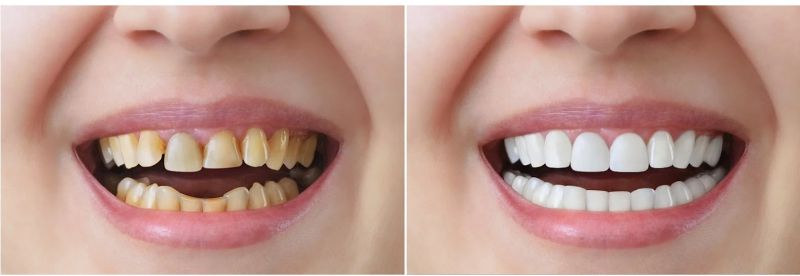 răng khấp khểnh có bọc sứ được không