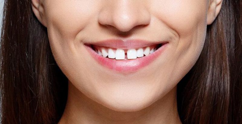 răng thưa nên niềng hay bọc sứ