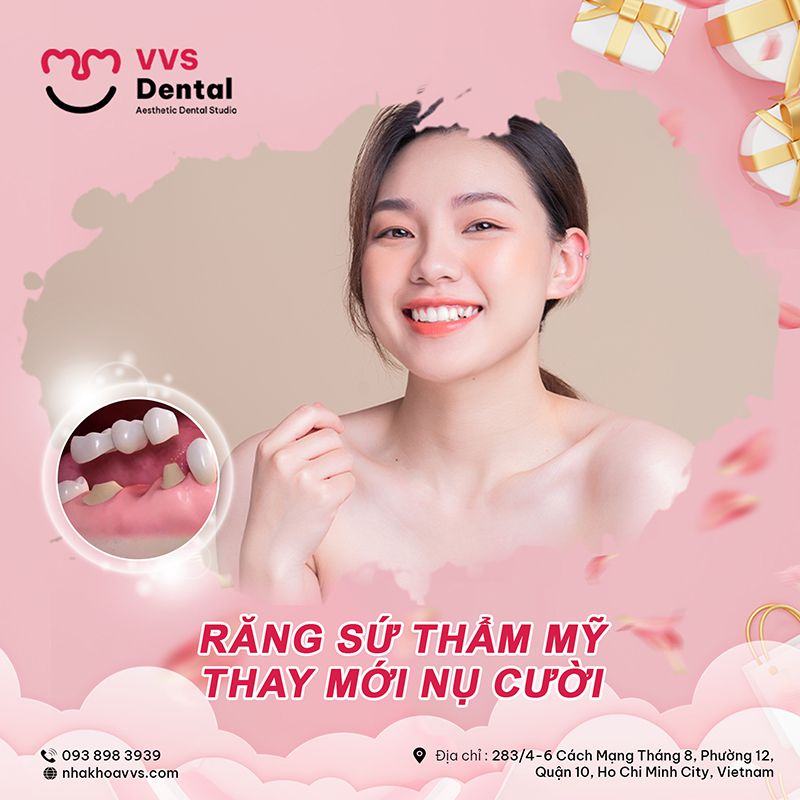 răng thưa nên niềng hay bọc sứ